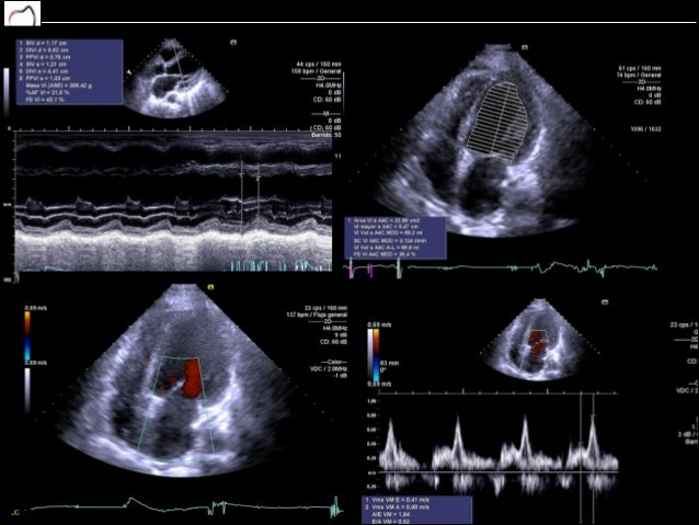 cardiotoxicidad por quimioterapia